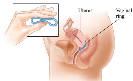 contraceptive_ring_in_place