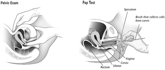 pelvic-exam-pap-test